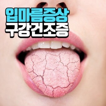 구강건조증(입 마름증)